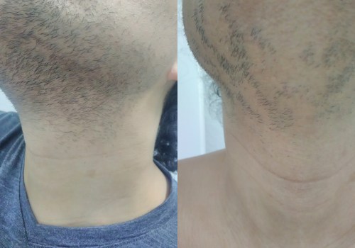 How Long Does Laser Hair Removal Last After 10 Sessions?