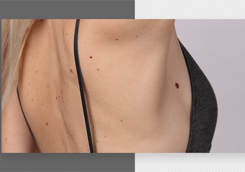 Laser Hair Removal and Moles: What You Need to Know