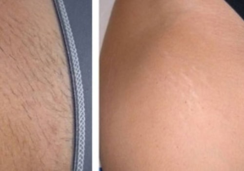 Is Laser Hair Removal the Best Way to Get Rid of Unwanted Hair?