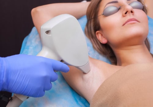 How Long Does Hair Stay Removed After Laser Hair Removal?